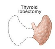 Thyroid-lobectomy