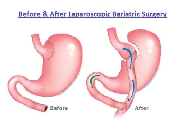 expect after laparoscopic bariatric surgery