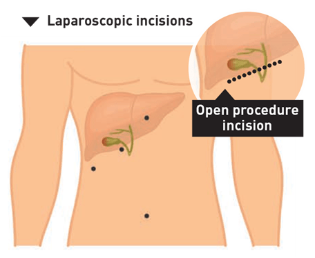 laproscopic incisions