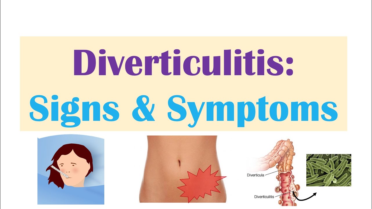 diverticulitis up to date