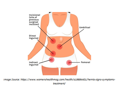 Types of hernias