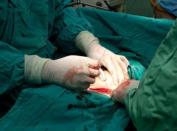 Doctors closing woman's belly after performing Caesarian section