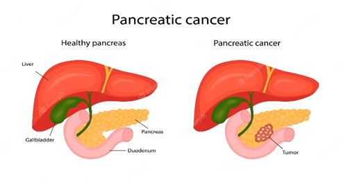 Pancreatic Stones without Gallbladder | Dr. Harsh Sheth