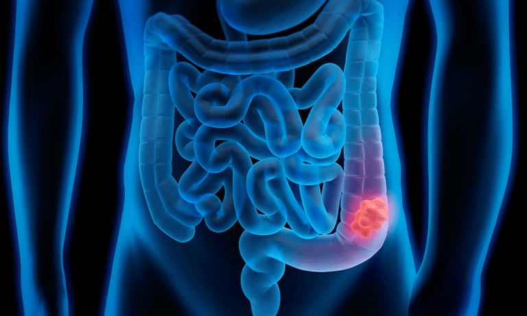 Colorectal cancers