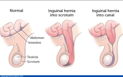 Inguinal Hernia Surgery – Post-Op Care Tips