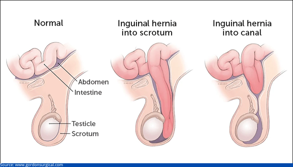 Inguinal Hernia Surgery – Post-Op Care Tips