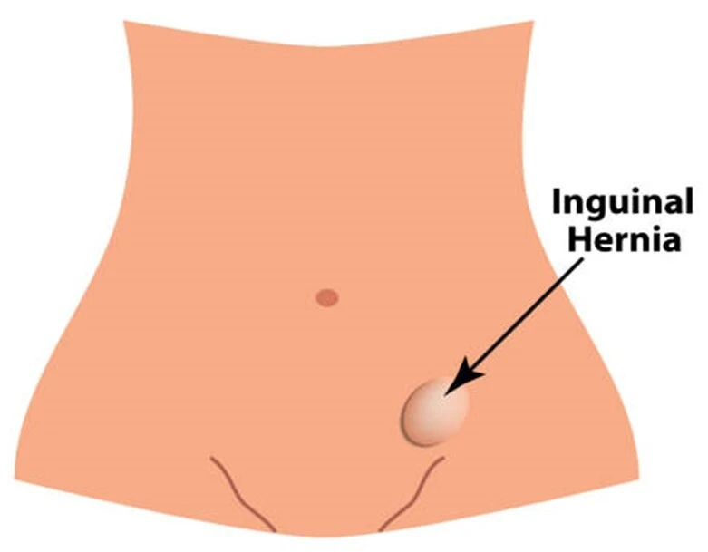 Laparoscopic Repair for Inguinal Hernia