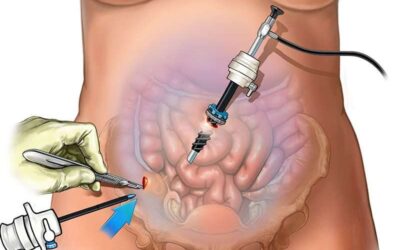 Everything You Must Know About Laparoscopy In Mumbai