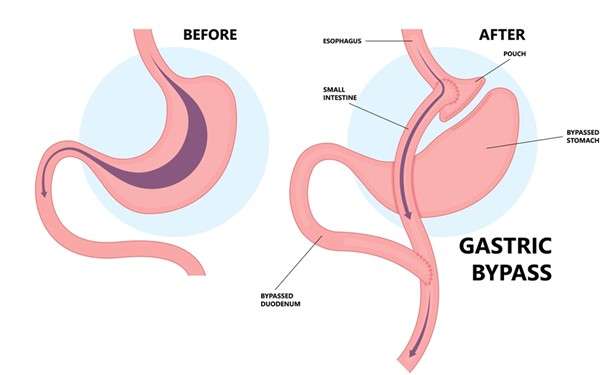 Life-Changing Impacts Post-Gastric Bypass