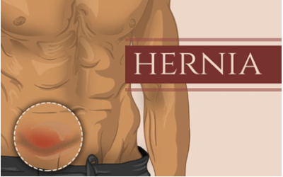 Signs that Indicate Towards Hernia