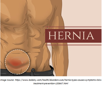 Signs that Indicate Towards Hernia