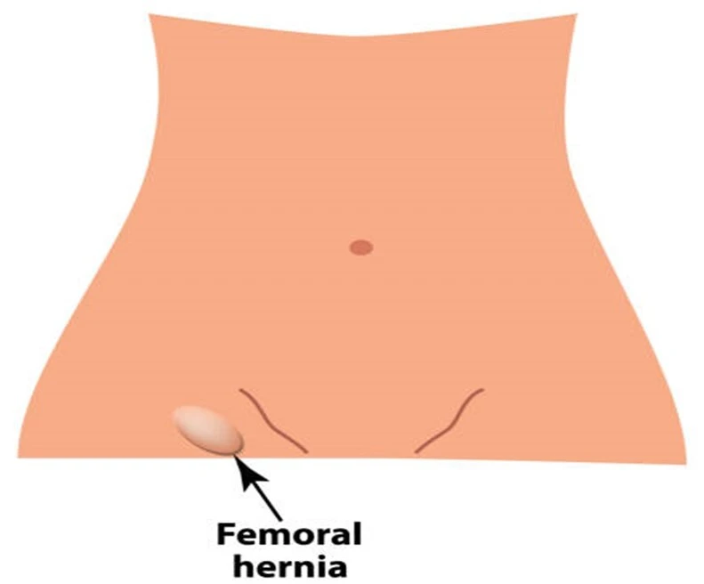 Surgical Repair for Femoral Hernia