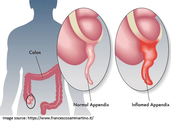 appendix can leak bacteria 