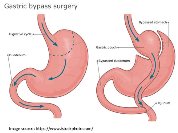 gastric bypass 