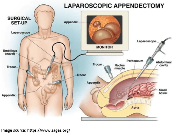  laparoscopic appendectomy