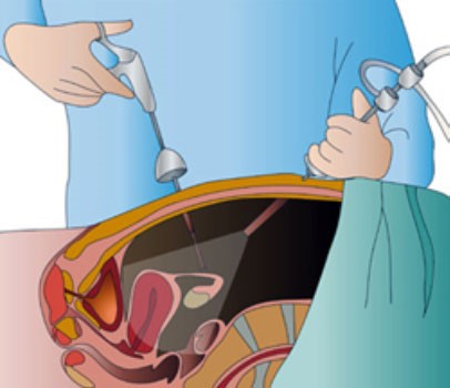 Laparoscopic bariatric surgery performed