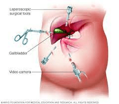 Laproscopic Cholecystectomy
