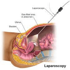Laproscopic Surgery