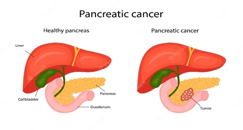 pancreatic stones