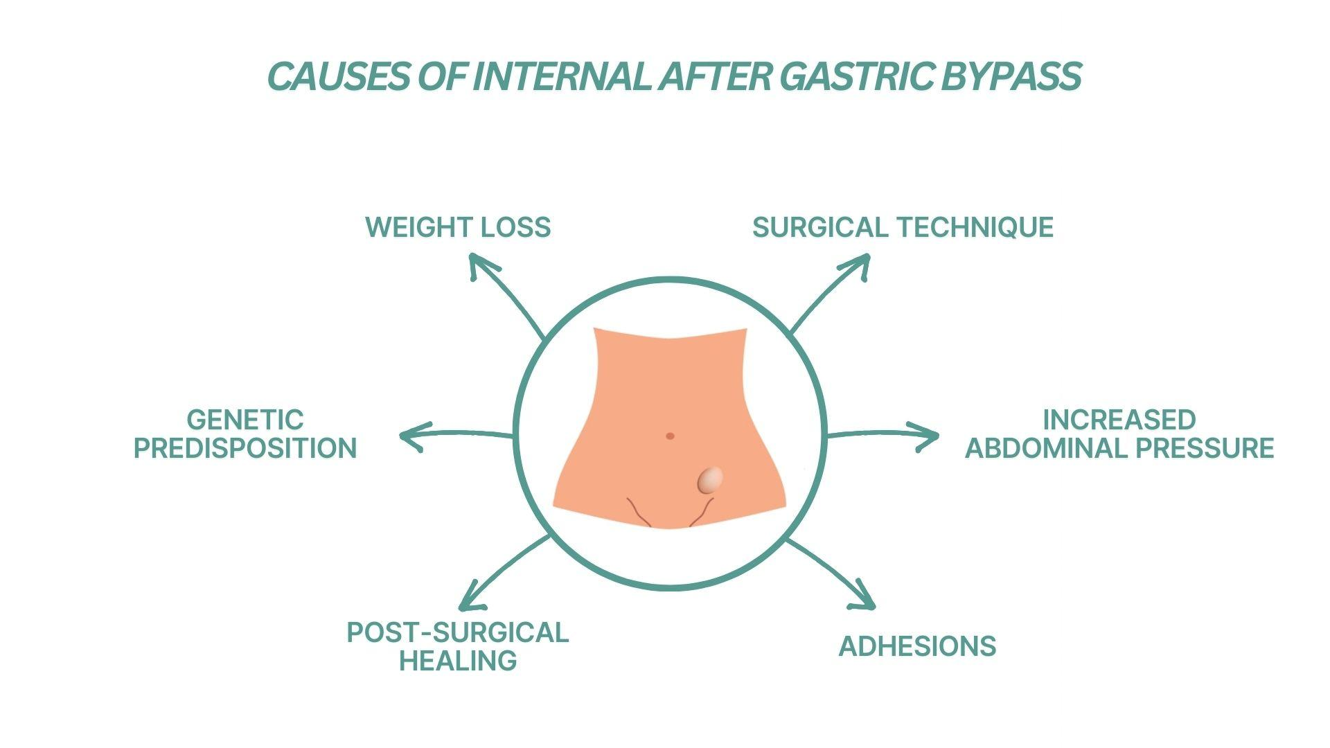 What Causes Internal Hernia After Gastric Bypass