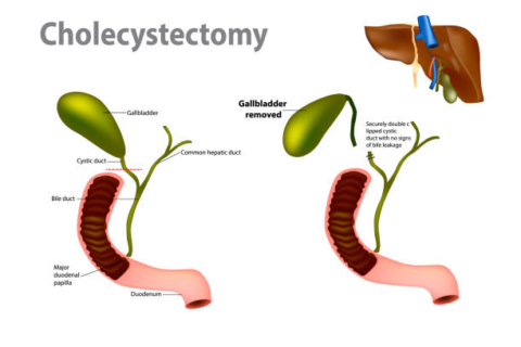 Back Pain Months After Gallbladder Removal | Dr. Harsh Sheth