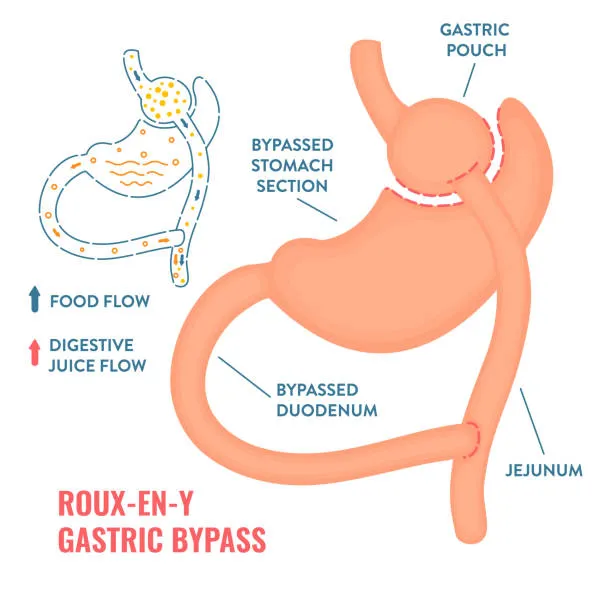 semaglutide after roux-en-y gastric bypass weight regain Roux-en-Y Gastric Bypass After Gastric Sleeve