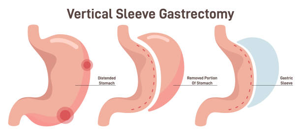 Comparing Weight Loss Outcomes: Gastric Sleeve vs Gastric Bypass
