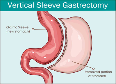 Is It Normal to Gain Weight 10 Years After Gastric Bypass Surgery?