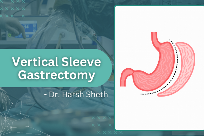 Vertical Sleeve Gastrectomy in Mumbai: Procedure, Recovery, and Results