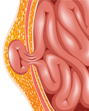 What Are the Common Causes of Long-Term Weight Regain After Gastric Bypass?