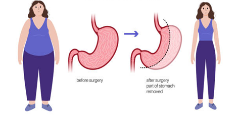 What Are the Common Causes of Long-Term Weight Regain After Gastric Bypass?