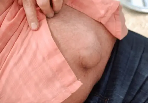 Hernias