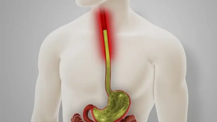 Upper GI Conditions 