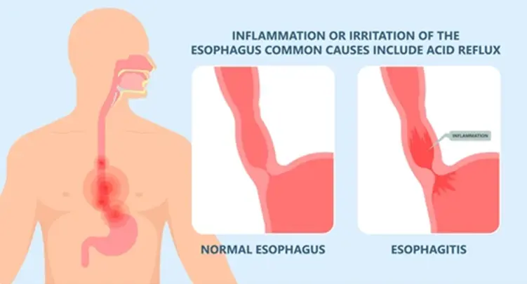 Esophageal Diseases