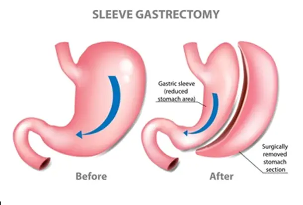 Robotic Sleeve Gastrectomy