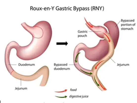 Robotic Roux-en-Y Gastric Bypass