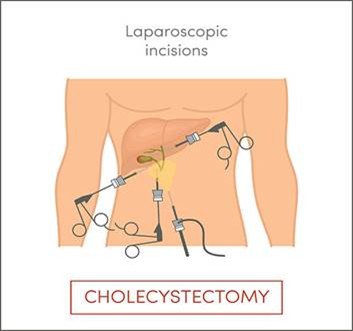 When Should Someone Consider Robotic GI Surgery?