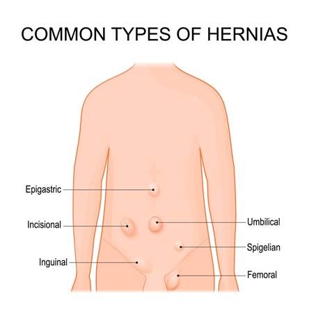 Possible Benefits of Robotic GI Surgery