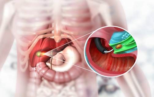 Robotic Gastrointestinal Surgery 
