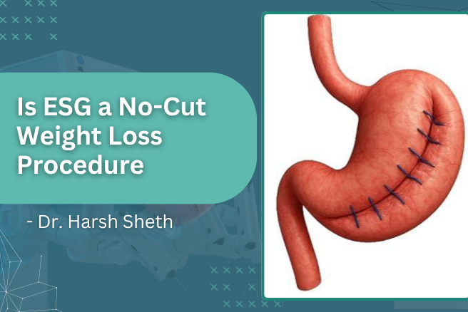 Dr. Harsh Sheth explaining ESG, a no-cut weight loss procedure using minimally invasive endoscopic treatment.