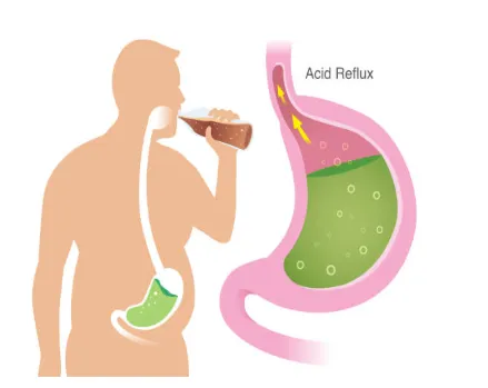 Screenshot 2026-08-11 163924 - Harsh Seth New Side-view illustration of a person drinking, with an inset diagram of the esophagus and stomach showing acid reflux moving upward toward the esophagus.