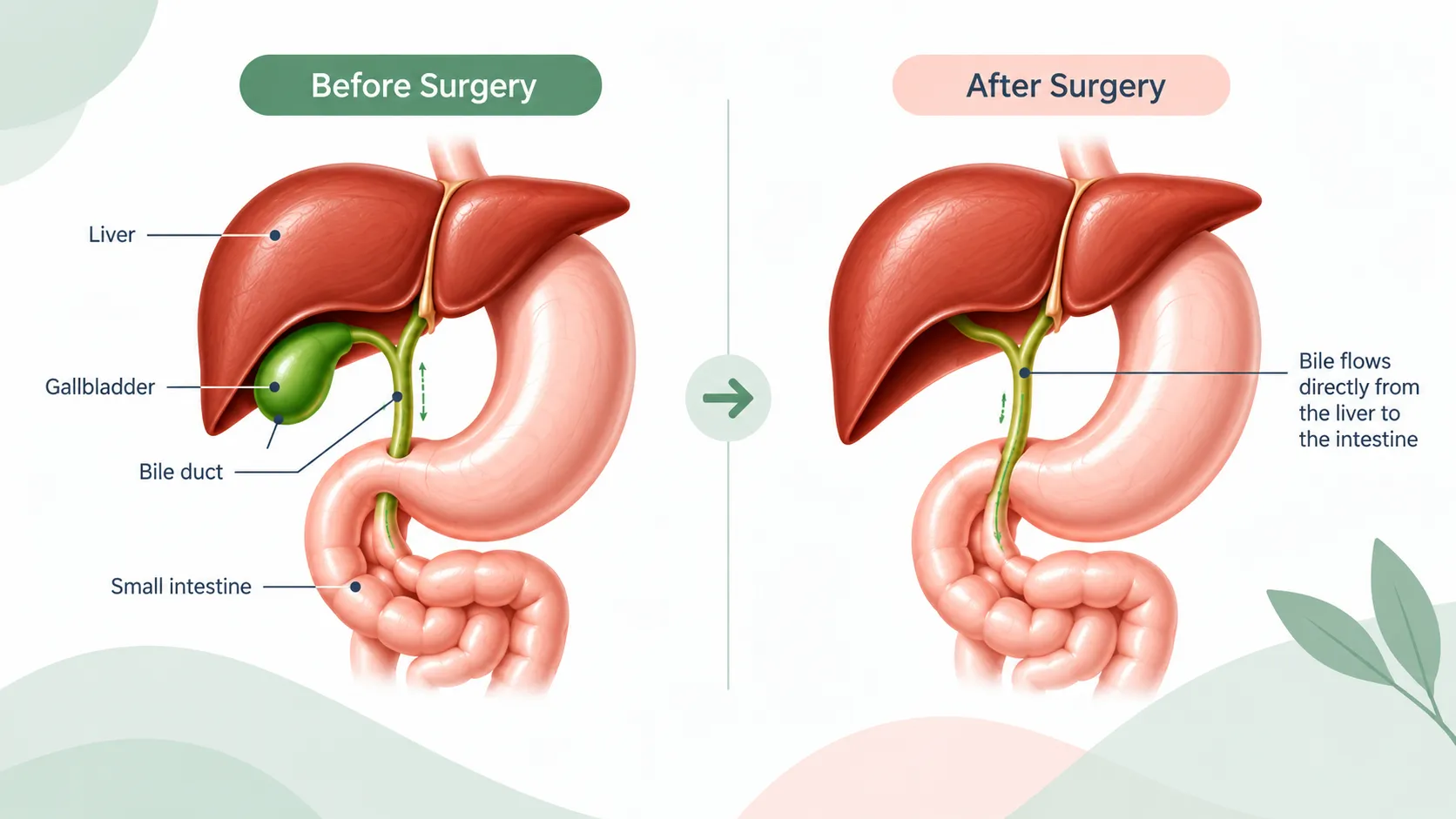 Diagram comparing liver and bile system before and after surgery, showing bile flowing directly from liver to intestine in the right panel.